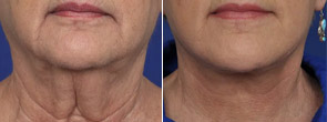 RF microneedling