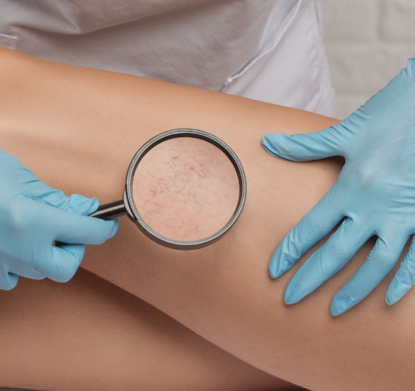 Karsprængninger på ben – glatte og ensartede ben med synlige resultater – 15%