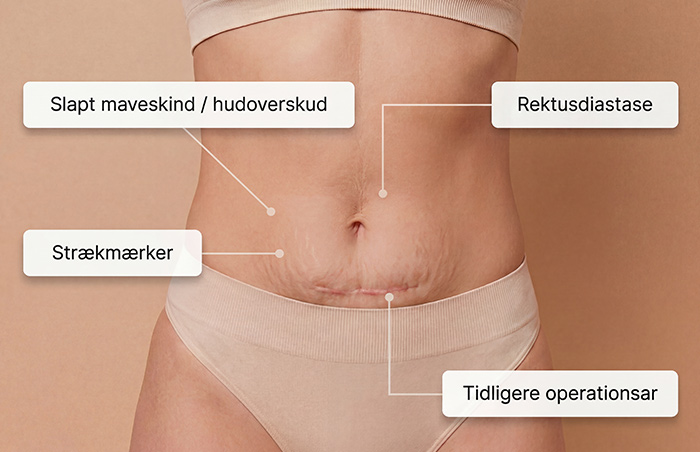 Maveopstramning  for alle
