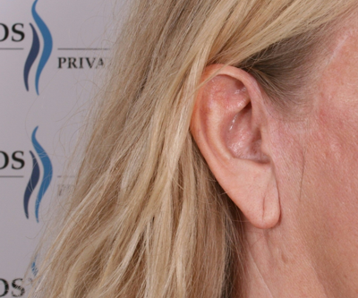 Store reduktion af øreflipper - og efterfotos, udført på AROS Privathospital