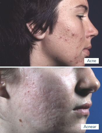 Acne og acnear - Speciallægepraksis i hudsygdomme AROS Privathospital