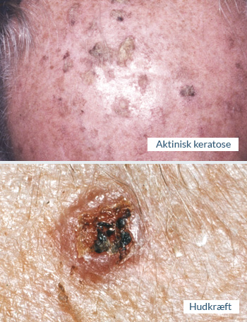 Aktinisk keratose og hudkræft - Speciallægepraksis i hudsygdomme AROS Privathospital