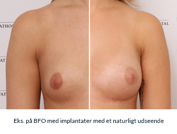Eks. på BFO med implantater med et naturligt udseende: