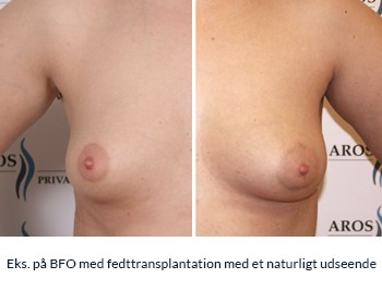 Eks. på BFO med fedttransplantation med et naturligt udseende: