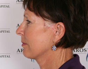 ansigt-cervical - ansigts og halsløft