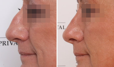 Fa Et Mere Harmonisk Ansigt Med En Naesekorrektion Rhinoplastik Hos Plastiskkirurgisk Center Pa Aros Privathospital I Aarhus Har Vi Stor Erfaring Med Udforelse Af Naesekorrektioner