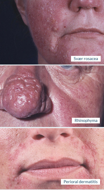 Roscea, rhinophyma, perioral dermatitis - Speciallægepraksis i hudsygdomme AROS Privathospital