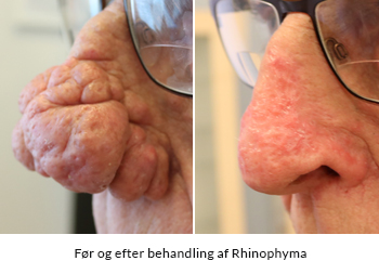 Før og efter behandling af Rhinophyma (kartoffelnæse) - behandlet på AROS Privathospital