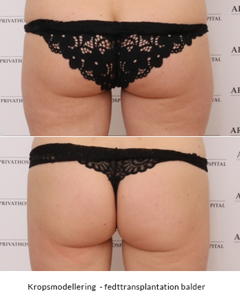 Balder, forstørrelse - Brazilian Butt Alle operationer udføres af professionelle og erfarne plastikkirurger.