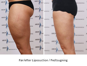 Før/ efter - fedtsugning - en reduktion af lårfylde og en normalisering af lårenes form