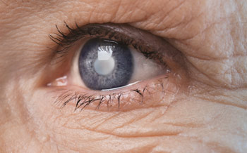 Ved grå stær forstår man enhver uklarhed i øjets linse, som ligger bag pupillen