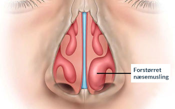 Typiske symptomer på forstørrede næsemuslinger er tilstoppet næse