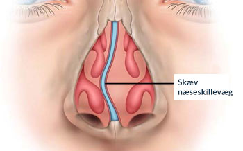 Illustration af en skæv næseskillevæg