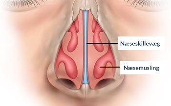 Nedsat luftpassage gennem næsen - illustration af næseskillevæg og næsemusling