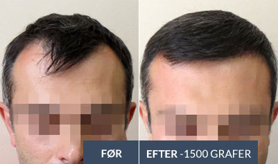 HÅRTRANSPLANTATIONER - nyhed
