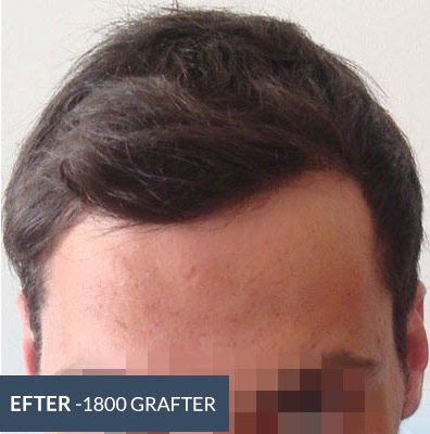 Hårtransplantation FUE - 1800 grafter - AROS Privathospital