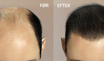 FUE hvor mange grafter skal jeg vælge?