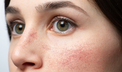 Ansigtsrødme og rosacea