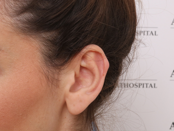 Reducering af øreflipper - før