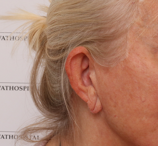 Store reduktion af øreflipper - og efterfotos, udført på AROS Privathospital