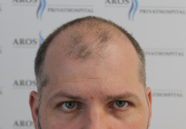 Før - FUE hårtransplantation 