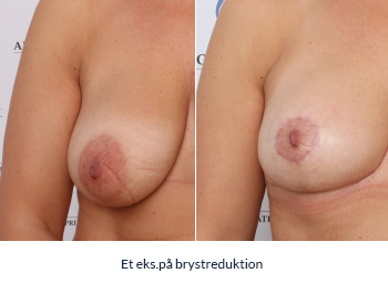 Brystreduktion - før-efter udført på AROS Privathospital