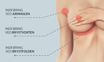 Implantat - arplacering