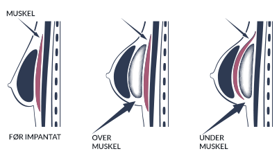 Implantat - over eller under brystmuskel